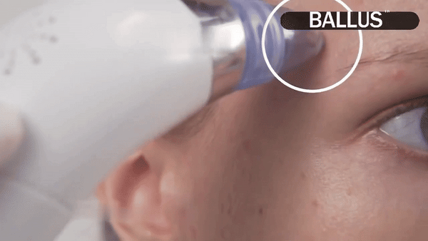 Pore Cleaning Device – Deep Clean, Blackhead Removal, Glowing Skin